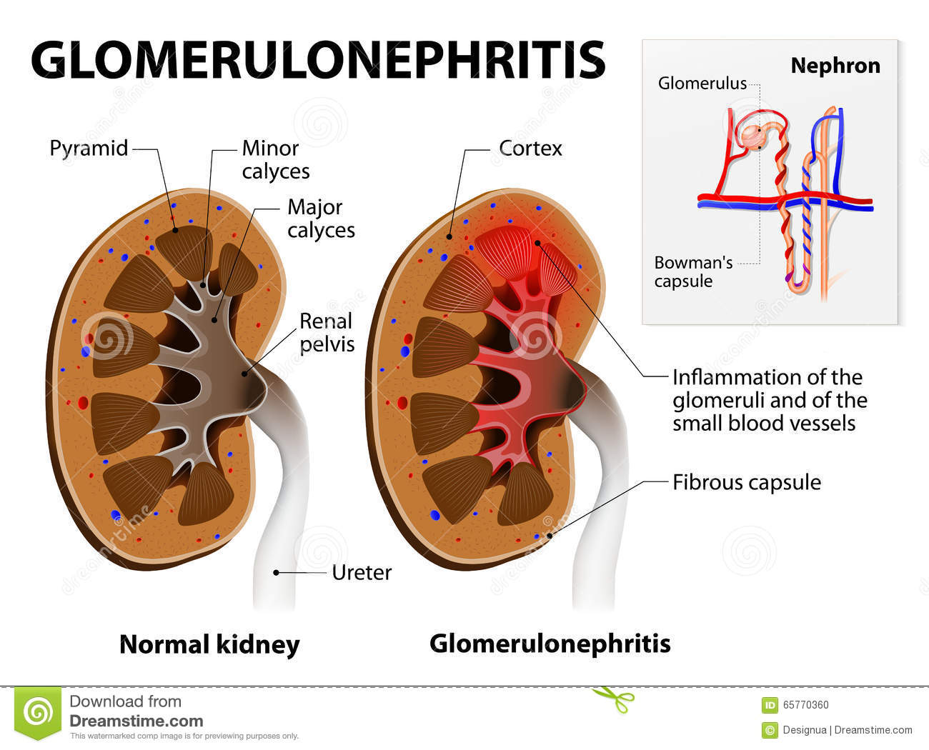 Glomerulonephrite ou nephrite glomerulaire maladie renale 65770360